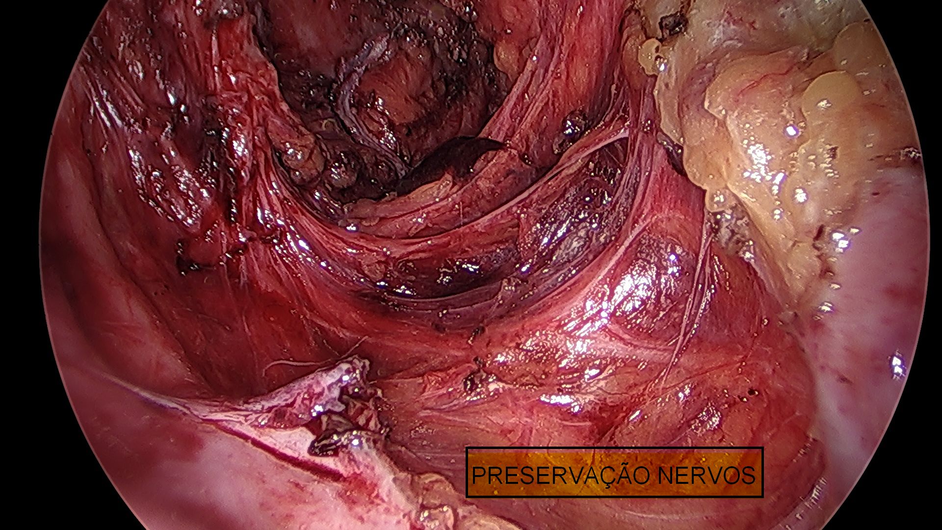 Ooforoplastia laparoscópica e exérese de lesão de endometriose profunda 