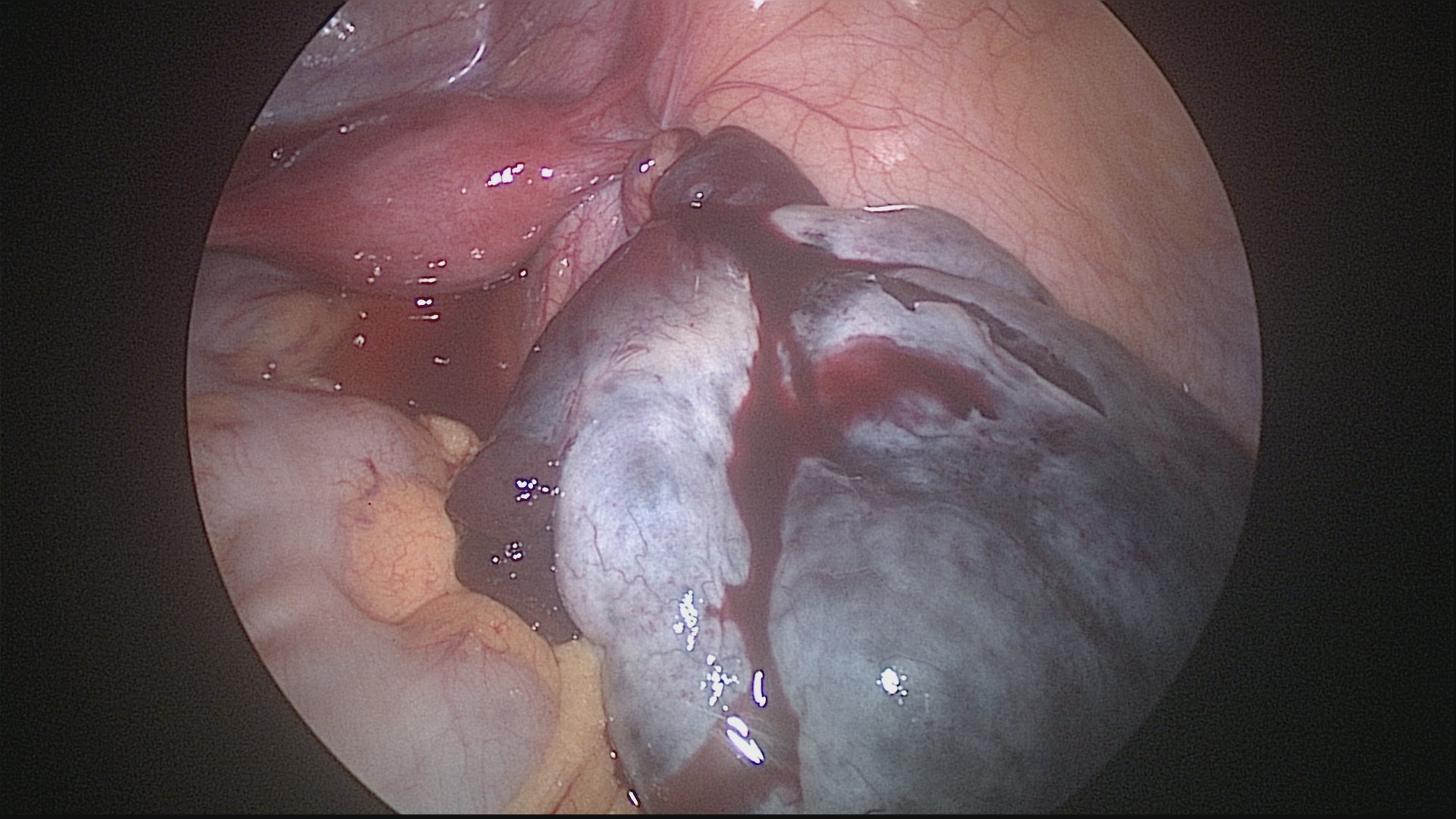 Cirurgias dos ovários: Ooforoplastia e Oofotectomia - Instituto Feminina