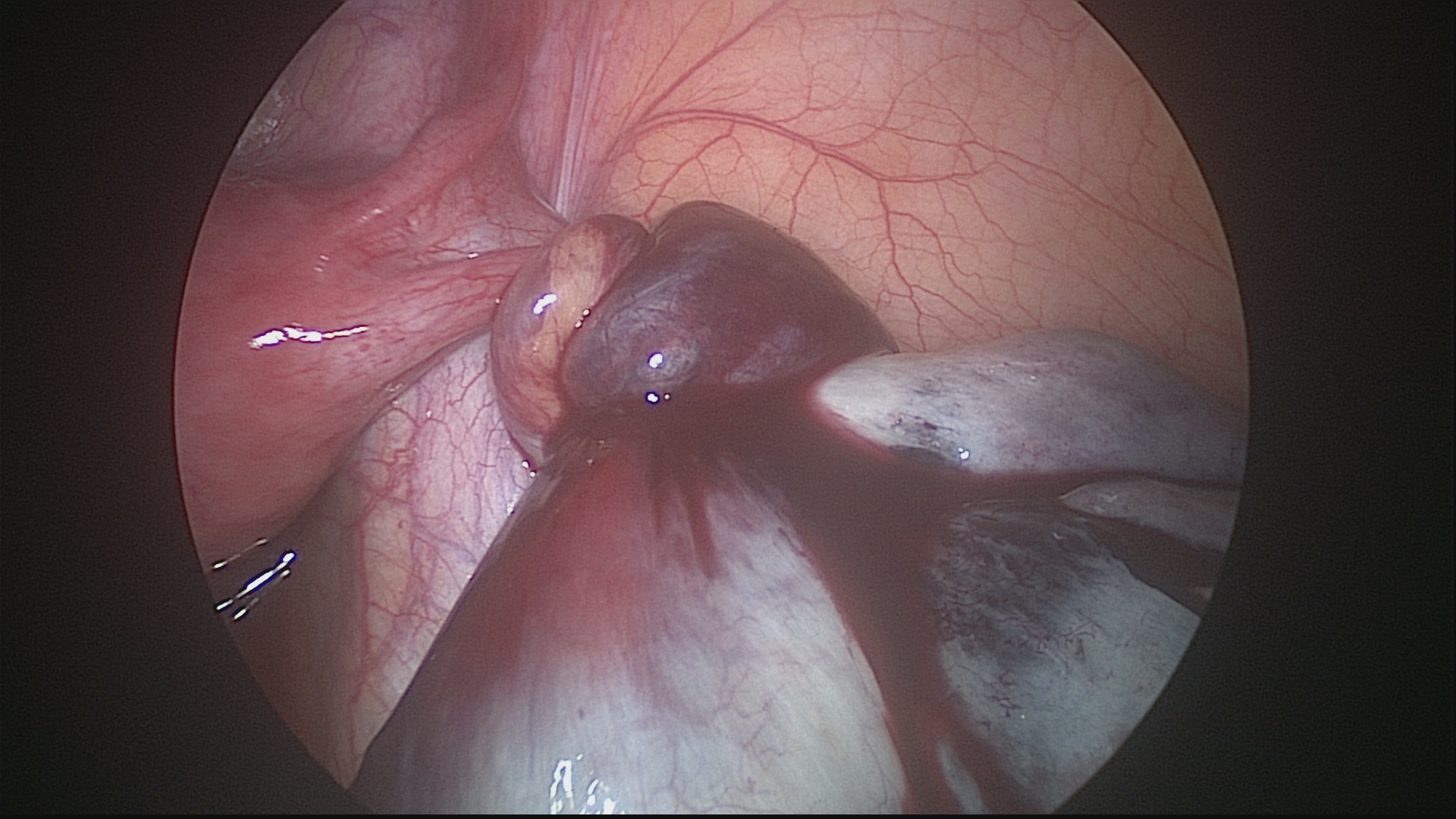 Ooforectomia esquerda laparoscópica com incisão única